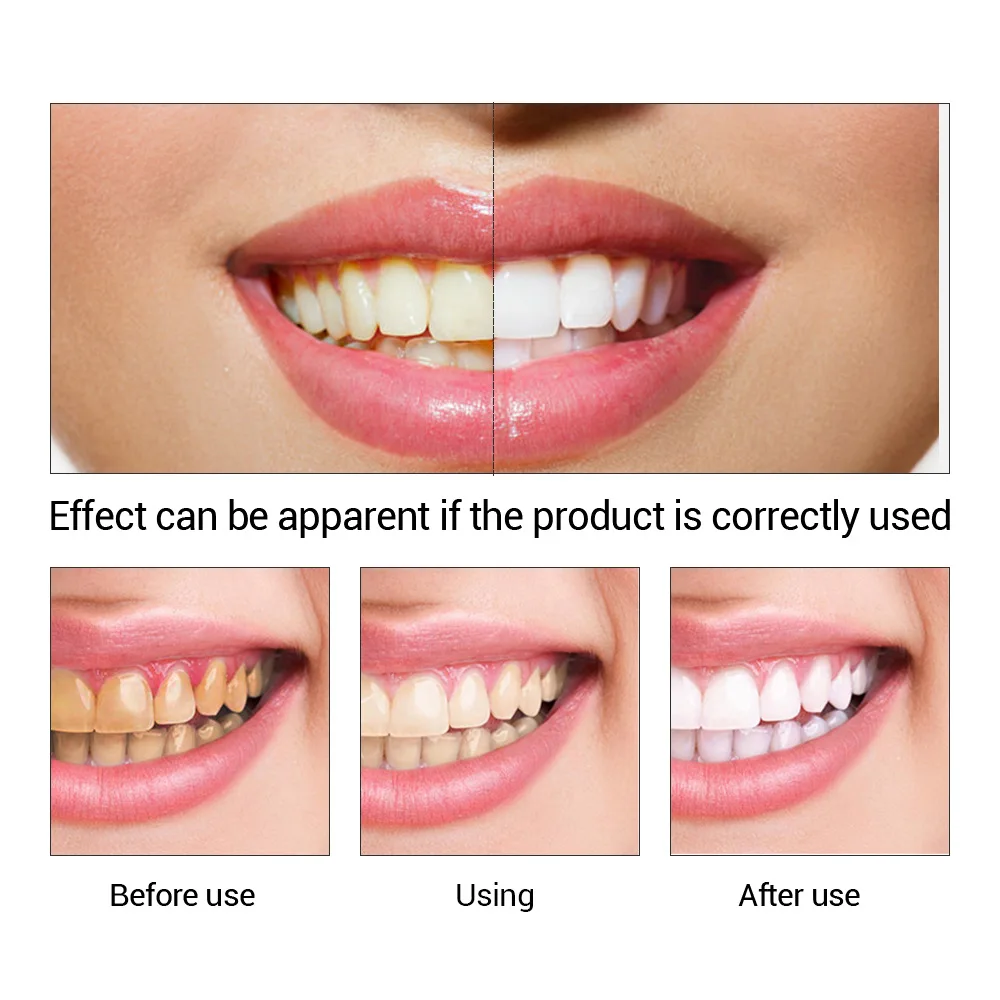 FTEENPLY Teeth Whitening Essen - Teeth Whitening Remedies 评论和价格