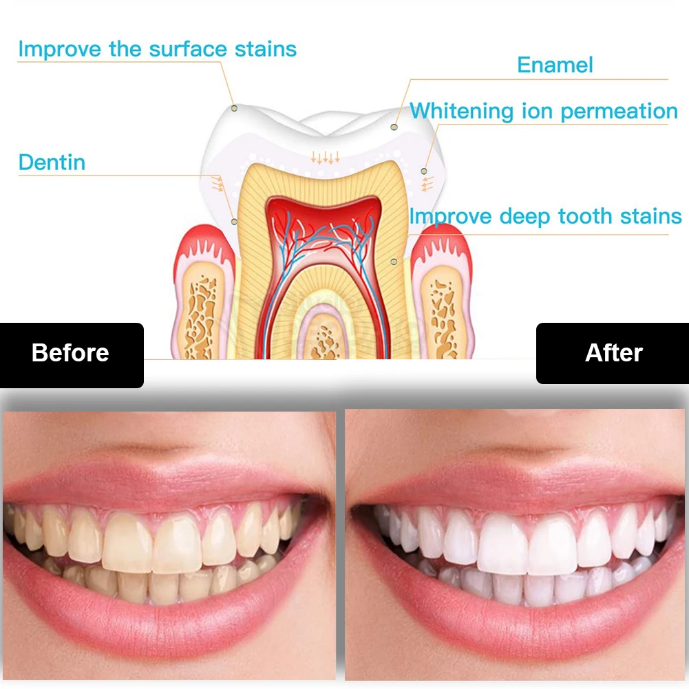 Dental Teeth Whitening Kit Min - Teeth Whitening Remedies 评论和价格